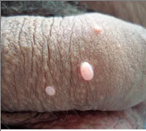 Molluscum contagiosum