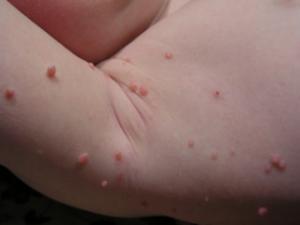 Molluscum contagiosum Molluscum contagiosum